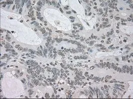 IHC-P analysis of colon adenocarcinoma tissue using GTX84062 NAT8 antibody [6H3]. Antigen retrieval : Heat-induced epitope retrieval by 10mM citrate buffer, pH6.0, 100oC for 10min. Dilution : 1:50