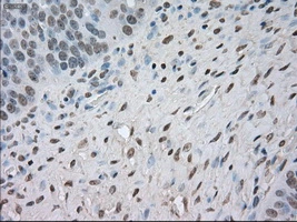 IHC-P analysis of human ovary adenocarcinoma tissue using GTX84062 NAT8 antibody [6H3]. Antigen retrieval : Heat-induced epitope retrieval by 10mM citrate buffer, pH6.0, 100oC for 10min. Dilution : 1:50