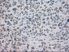 IHC-P analysis of bladder carcinoma tissue using GTX84062 NAT8 antibody [6H3]. Antigen retrieval : Heat-induced epitope retrieval by 10mM citrate buffer, pH6.0, 100oC for 10min. Dilution : 1:50
