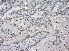 IHC-P analysis of kidney carcinoma tissue using GTX84062 NAT8 antibody [6H3]. Antigen retrieval : Heat-induced epitope retrieval by 10mM citrate buffer, pH6.0, 100oC for 10min. Dilution : 1:50