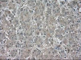 IHC-P analysis of liver carcinoma tissue using GTX84062 NAT8 antibody [6H3]. Antigen retrieval : Heat-induced epitope retrieval by 10mM citrate buffer, pH6.0, 100oC for 10min. Dilution : 1:50