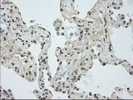 IHC-P analysis of lung carcinoma tissue using GTX84062 NAT8 antibody [6H3]. Antigen retrieval : Heat-induced epitope retrieval by 10mM citrate buffer, pH6.0, 100oC for 10min. Dilution : 1:50