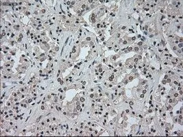 IHC-P analysis of prostate carcinoma tissue using GTX84062 NAT8 antibody [6H3]. Antigen retrieval : Heat-induced epitope retrieval by 10mM citrate buffer, pH6.0, 100oC for 10min. Dilution : 1:50