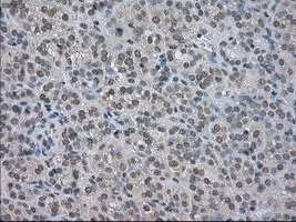IHC-P analysis of thyroid carcinoma tissue using GTX84062 NAT8 antibody [6H3]. Antigen retrieval : Heat-induced epitope retrieval by 10mM citrate buffer, pH6.0, 100oC for 10min. Dilution : 1:50