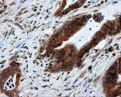 IHC-P analysis of colon adenocarcinoma tissue using GTX84071 MTRF1L antibody [1B3]. Antigen retrieval : Heat-induced epitope retrieval by 10mM citrate buffer, pH6.0, 100oC for 10min. Dilution : 1:50