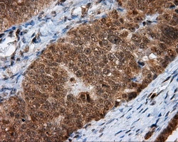IHC-P analysis of human ovary adenocarcinoma tissue using GTX84071 MTRF1L antibody [1B3]. Antigen retrieval : Heat-induced epitope retrieval by 10mM citrate buffer, pH6.0, 100oC for 10min. Dilution : 1:50