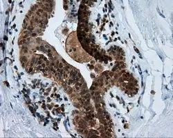 IHC-P analysis of breast tissue using GTX84071 MTRF1L antibody [1B3]. Antigen retrieval : Heat-induced epitope retrieval by 10mM citrate buffer, pH6.0, 100oC for 10min. Dilution : 1:50
