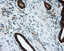 IHC-P analysis of prostate carcinoma tissue using GTX84071 MTRF1L antibody [1B3]. Antigen retrieval : Heat-induced epitope retrieval by 10mM citrate buffer, pH6.0, 100oC for 10min. Dilution : 1:50