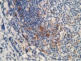 IHC-P analysis of human lymphoma tissue using GTX84126 MICAL1 antibody [6H10]. Dilution : 1:150