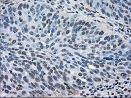 IHC-P analysis of human ovary adenocarcinoma tissue using GTX84154 ERK2 antibody [6F8]. Antigen retrieval : Heat-induced epitope retrieval by 10mM citrate buffer, pH6.0, 100oC for 10min.
