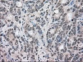 IHC-P analysis of colon adenocarcinoma tissue using GTX84159 ERK2 antibody [6E5]. Antigen retrieval : Heat-induced epitope retrieval by 10mM citrate buffer, pH6.0, 100oC for 10min. Dilution : 1:50