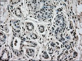 IHC-P analysis of breast tissue using GTX84159 ERK2 antibody [6E5]. Antigen retrieval : Heat-induced epitope retrieval by 10mM citrate buffer, pH6.0, 100oC for 10min. Dilution : 1:50