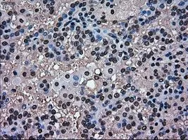 IHC-P analysis of kidney carcinoma tissue using GTX84159 ERK2 antibody [6E5]. Antigen retrieval : Heat-induced epitope retrieval by 10mM citrate buffer, pH6.0, 100oC for 10min. Dilution : 1:50