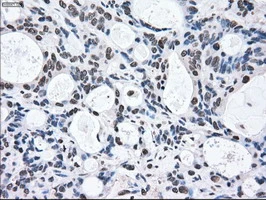 IHC-P analysis of human colon adenocarcinoma tissue using GTX84165 MEK2 antibody [8G6]. Antigen retrieval : Heat-induced epitope retrieval by 10mM citrate buffer, pH6.0, 100oC for 10min.
