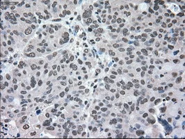IHC-P analysis of human endometrium adenocarcinoma tissue using GTX84165 MEK2 antibody [8G6]. Antigen retrieval : Heat-induced epitope retrieval by 10mM citrate buffer, pH6.0, 100oC for 10min.
