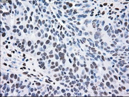 IHC-P analysis of human ovary adenocarcinoma tissue using GTX84165 MEK2 antibody [8G6]. Antigen retrieval : Heat-induced epitope retrieval by 10mM citrate buffer, pH6.0, 100oC for 10min.