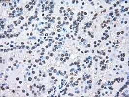 IHC-P analysis of human kidney carcinoma tissue using GTX84165 MEK2 antibody [8G6]. Antigen retrieval : Heat-induced epitope retrieval by 10mM citrate buffer, pH6.0, 100oC for 10min.