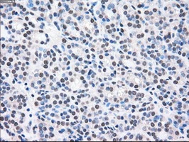 IHC-P analysis of human thyroid carcinoma tissue using GTX84165 MEK2 antibody [8G6]. Antigen retrieval : Heat-induced epitope retrieval by 10mM citrate buffer, pH6.0, 100oC for 10min.