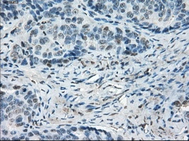 IHC-P analysis of human ovary adenocarcinoma tissue using GTX84170 LTA4H antibody [1E9]. Antigen retrieval : Heat-induced epitope retrieval by 10mM citrate buffer, pH6.0, 100oC for 10min. Dilution : 1:50