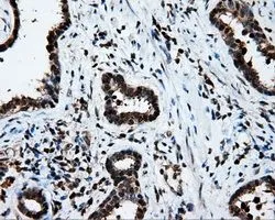 IHC-P analysis of prostate carcinoma tissue using GTX84173 LTA4H antibody [6B5]. Antigen retrieval : Heat-induced epitope retrieval by 10mM citrate buffer, pH6.0, 100oC for 10min. Dilution : 1:50