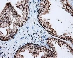 IHC-P analysis of prostate tissue using GTX84173 LTA4H antibody [6B5]. Antigen retrieval : Heat-induced epitope retrieval by 10mM citrate buffer, pH6.0, 100oC for 10min. Dilution : 1:50