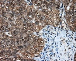 IHC-P analysis of human ovary adenocarcinoma tissue using GTX84191 Endothelial Lipase / LIPG antibody [4A8]. Antigen retrieval : Heat-induced epitope retrieval by 10mM citrate buffer, pH6.0, 100oC for 10min.