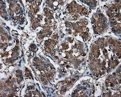IHC-P analysis of human liver carcinoma tissue using GTX84191 Endothelial Lipase / LIPG antibody [4A8]. Antigen retrieval : Heat-induced epitope retrieval by 10mM citrate buffer, pH6.0, 100oC for 10min.