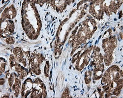 IHC-P analysis of human prostate carcinoma tissue using GTX84191 Endothelial Lipase / LIPG antibody [4A8]. Antigen retrieval : Heat-induced epitope retrieval by 10mM citrate buffer, pH6.0, 100oC for 10min.