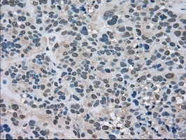 IHC-P analysis of human bladder carcinoma tissue using GTX84226 LDHA antibody [5G10]. Antigen retrieval : Heat-induced epitope retrieval by 10mM citrate buffer, pH6.0, 100oC for 10min.