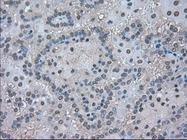 IHC-P analysis of human kidney carcinoma tissue using GTX84226 LDHA antibody [5G10]. Antigen retrieval : Heat-induced epitope retrieval by 10mM citrate buffer, pH6.0, 100oC for 10min.