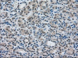 IHC-P analysis of human thyroid carcinoma tissue using GTX84226 LDHA antibody [5G10]. Antigen retrieval : Heat-induced epitope retrieval by 10mM citrate buffer, pH6.0, 100oC for 10min.