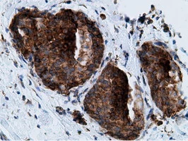 IHC-P analysis of human breast adenocarcinoma tissue using GTX84277 Ketohexokinase antibody [3D1]. Antigen retrieval : Heat-induced epitope retrieval by 10mM citrate buffer, pH6.0, 100oC for 10min.