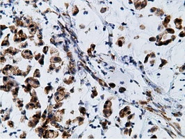 IHC-P analysis of human colon adenocarcinoma tissue using GTX84277 Ketohexokinase antibody [3D1]. Antigen retrieval : Heat-induced epitope retrieval by 10mM citrate buffer, pH6.0, 100oC for 10min.