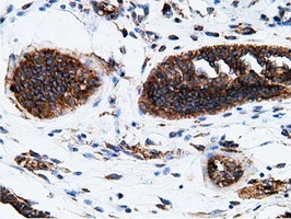 IHC-P analysis of human endometrium adenocarcinoma tissue using GTX84277 Ketohexokinase antibody [3D1]. Antigen retrieval : Heat-induced epitope retrieval by 10mM citrate buffer, pH6.0, 100oC for 10min.