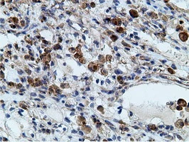 IHC-P analysis of human kidney carcinoma tissue using GTX84277 Ketohexokinase antibody [3D1]. Antigen retrieval : Heat-induced epitope retrieval by 10mM citrate buffer, pH6.0, 100oC for 10min.