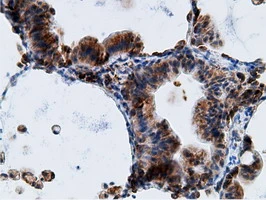 IHC-P analysis of human lung carcinoma tissue using GTX84277 Ketohexokinase antibody [3D1]. Antigen retrieval : Heat-induced epitope retrieval by 10mM citrate buffer, pH6.0, 100oC for 10min.