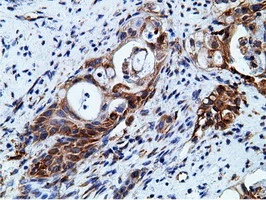 IHC-P analysis of human pancreas carcinoma tissue using GTX84277 Ketohexokinase antibody [3D1]. Antigen retrieval : Heat-induced epitope retrieval by 10mM citrate buffer, pH6.0, 100oC for 10min.
