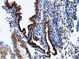 IHC-P analysis of human prostate carcinoma tissue using GTX84277 Ketohexokinase antibody [3D1]. Antigen retrieval : Heat-induced epitope retrieval by 10mM citrate buffer, pH6.0, 100oC for 10min.