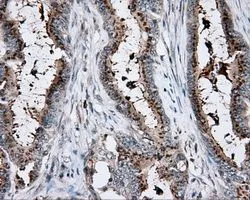 IHC-P analysis of colon adenocarcinoma tissue using GTX84281 KCTD5 antibody [3C8]. Antigen retrieval : Heat-induced epitope retrieval by 10mM citrate buffer, pH6.0, 100oC for 10min. Dilution : 1:50