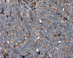 IHC-P analysis of human ovary adenocarcinoma tissue using GTX84281 KCTD5 antibody [3C8]. Antigen retrieval : Heat-induced epitope retrieval by 10mM citrate buffer, pH6.0, 100oC for 10min. Dilution : 1:50