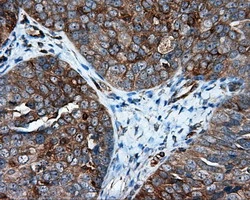 IHC-P analysis of human ovary adenocarcinoma tissue using GTX84315 IFIT1 antibody [3G8]. Antigen retrieval : Heat-induced epitope retrieval by 10mM citrate buffer, pH6.0, 100oC for 10min.