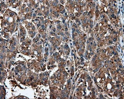 IHC-P analysis of human liver carcinoma tissue using GTX84315 IFIT1 antibody [3G8]. Antigen retrieval : Heat-induced epitope retrieval by 10mM citrate buffer, pH6.0, 100oC for 10min.
