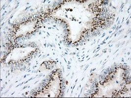 IHC-P analysis of human colon adenocarcinoma tissue using GTX84338 Hsp70 antibody [3C6]. Antigen retrieval : Heat-induced epitope retrieval by 10mM citrate buffer, pH6.0, 100oC for 10min. Dilution : 1:50