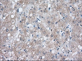 IHC-P analysis of human liver tissue using GTX84338 Hsp70 antibody [3C6]. Antigen retrieval : Heat-induced epitope retrieval by 10mM citrate buffer, pH6.0, 100oC for 10min. Dilution : 1:50