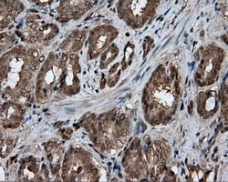 IHC-P analysis of human prostate carcinoma tissue using GTX84456 GBE1 antibody [3B4]. Antigen retrieval : Heat-induced epitope retrieval by 10mM citrate buffer, pH6.0, 100oC for 10min.