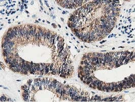 IHC-P analysis of human endometrium adenocarcinoma tissue using GTX84609 DNAJA2 antibody [3H10]. Antigen retrieval : Heat-induced epitope retrieval by 10mM citrate buffer, pH6.0, 100oC for 10min.