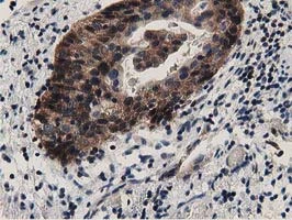 IHC-P analysis of human bladder carcinoma tissue using GTX84609 DNAJA2 antibody [3H10]. Antigen retrieval : Heat-induced epitope retrieval by 10mM citrate buffer, pH6.0, 100oC for 10min.