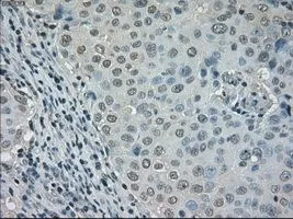 IHC-P analysis of breast adenocarcinoma tissue using GTX84617 DHFR antibody [6G7]. Antigen retrieval : Heat-induced epitope retrieval by 10mM citrate buffer, pH6.0, 100oC for 10min. Dilution : 1:50