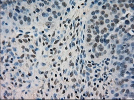 IHC-P analysis of human ovary adenocarcinoma tissue using GTX84617 DHFR antibody [6G7]. Antigen retrieval : Heat-induced epitope retrieval by 10mM citrate buffer, pH6.0, 100oC for 10min. Dilution : 1:50