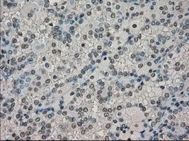 IHC-P analysis of kidney carcinoma tissue using GTX84617 DHFR antibody [6G7]. Antigen retrieval : Heat-induced epitope retrieval by 10mM citrate buffer, pH6.0, 100oC for 10min. Dilution : 1:50